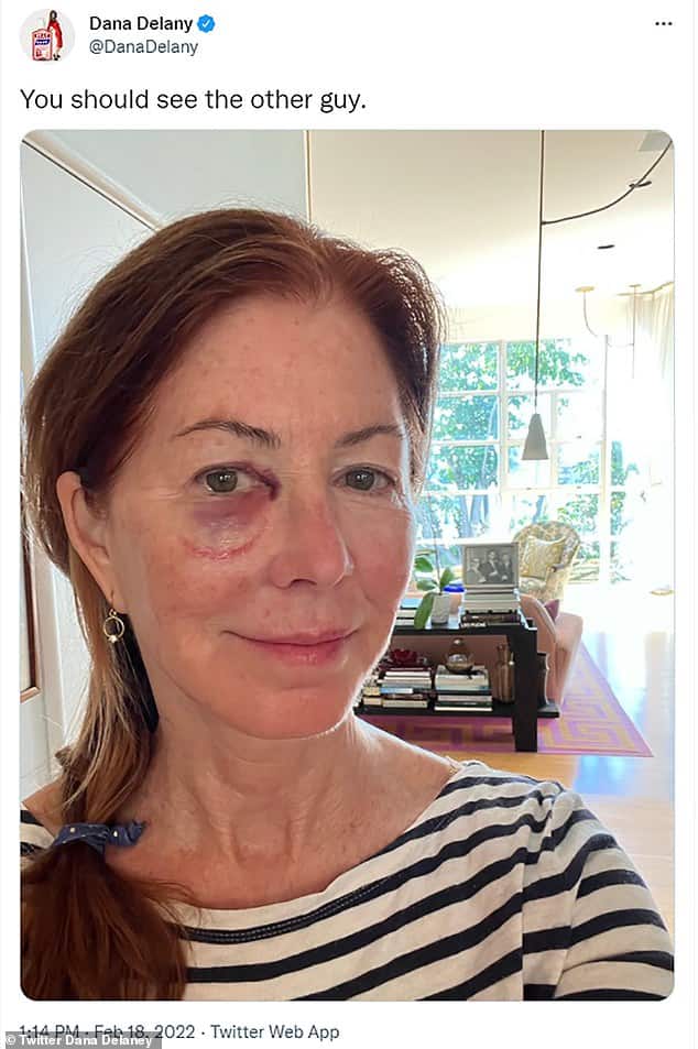 The latest: Dana Delany, 65, said that the recent death of her friend Bob Saget at 65 from head trauma inspired her to get her head examined after she fell down a staircase.  She was seen Friday showing a black eye she suffered in the fall