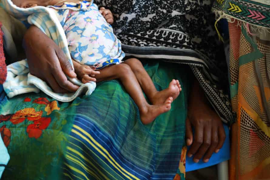 A mother holds a severely malnourished baby on her lap